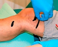 Как правильно ставить пиявки при варикозе вен на ногах? Как правильно ставить пиявки при варикозе вен на ногах?